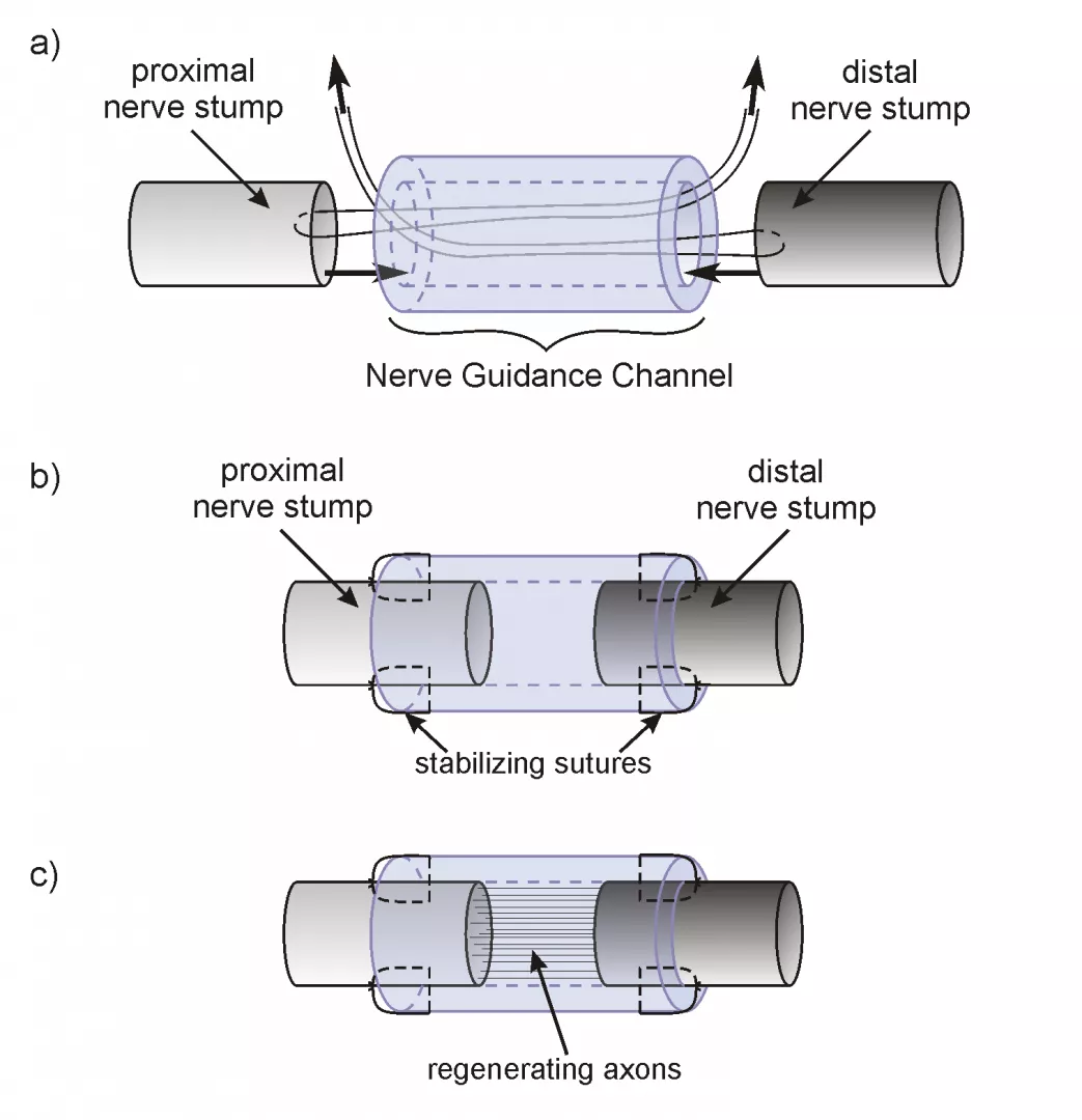 Tubulizacja – osłonkę nerwową nasuwa się na uszkodzone końce nerwu (stumps) i stabilizuje kilkoma szwami do onerwia